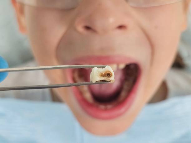 Best Emergency Tooth Extraction in Pawnee, IL