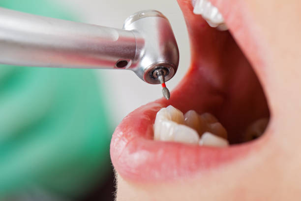 Best Emergency Tooth Extraction in Pawnee, IL